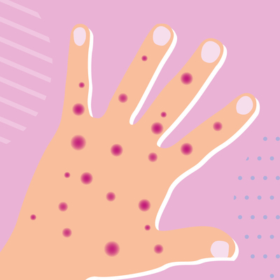 Penyakit Menular Real Time PCR Monkeypox Test Kit MPXV CE Terdaftar 1 Test/Box